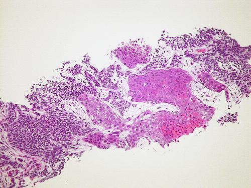 cancer cell.jpg